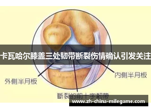 卡瓦哈尔膝盖三处韧带断裂伤情确认引发关注 卡瓦哈尔膝盖三处韧带断裂伤情确认引发关注
